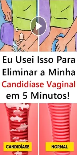 Eu Usei Isso Para Eliminar a Minha Candidíase Vaginal em Minutos!