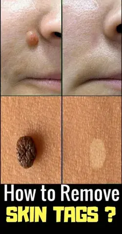 Quick, Easy, Cheap Home Remedy to Get Rid of Skin Tags