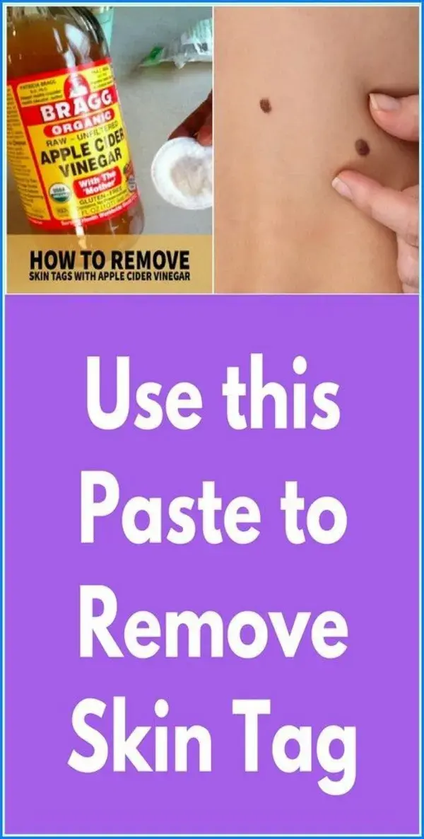 How to Remove Skin Tag in 1 Night