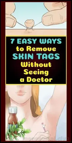 HOW TO REMOVE SKIN TAG IN 1 NIGHT