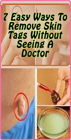 7 Easy Ways to Remove Skin Tags Without Visiting a Doctor