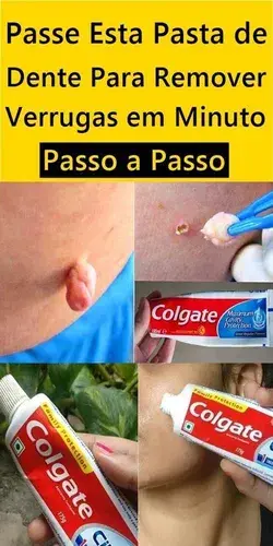 Passe Esta Pasta de Dente Para Remover Verrugas em Minuto!