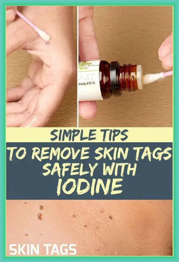 How to Remove Skin Tag in 1 Night