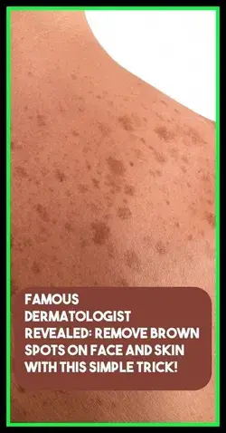 - Famous Dermatologist Revealed: Remove Brown Spots On Face And Skin With This Simple Trick!