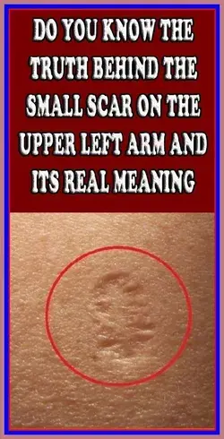 Do You Know The Truth Behind The Small Scar On The Upper Left Arm And Its Real Meaning