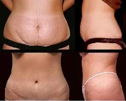 Tips For Effective Stretch Mark Removal Dubai