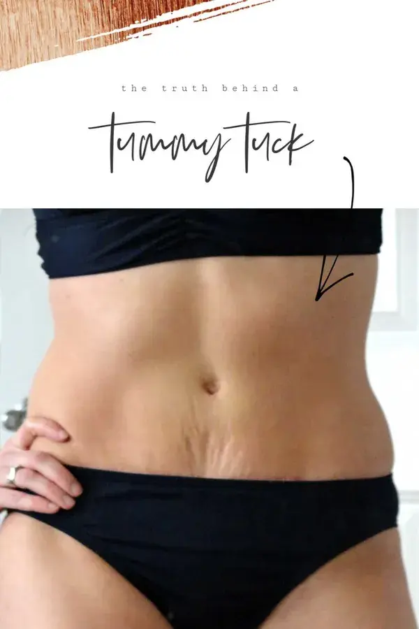 The truth behind a tummy tuck