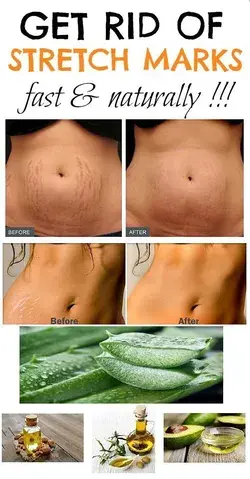 HOW TO GET RID OF STRETCH MARKS - BEAUTY BLOG