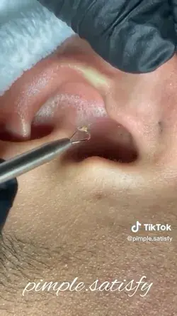 Satisfying Blackheads