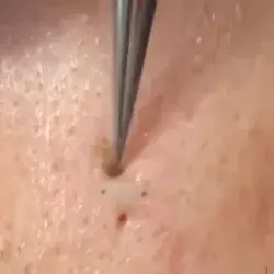 Blackheads removal