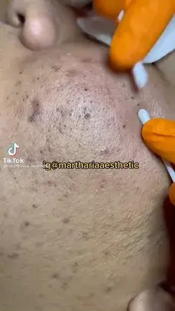 blackheads satisfying video