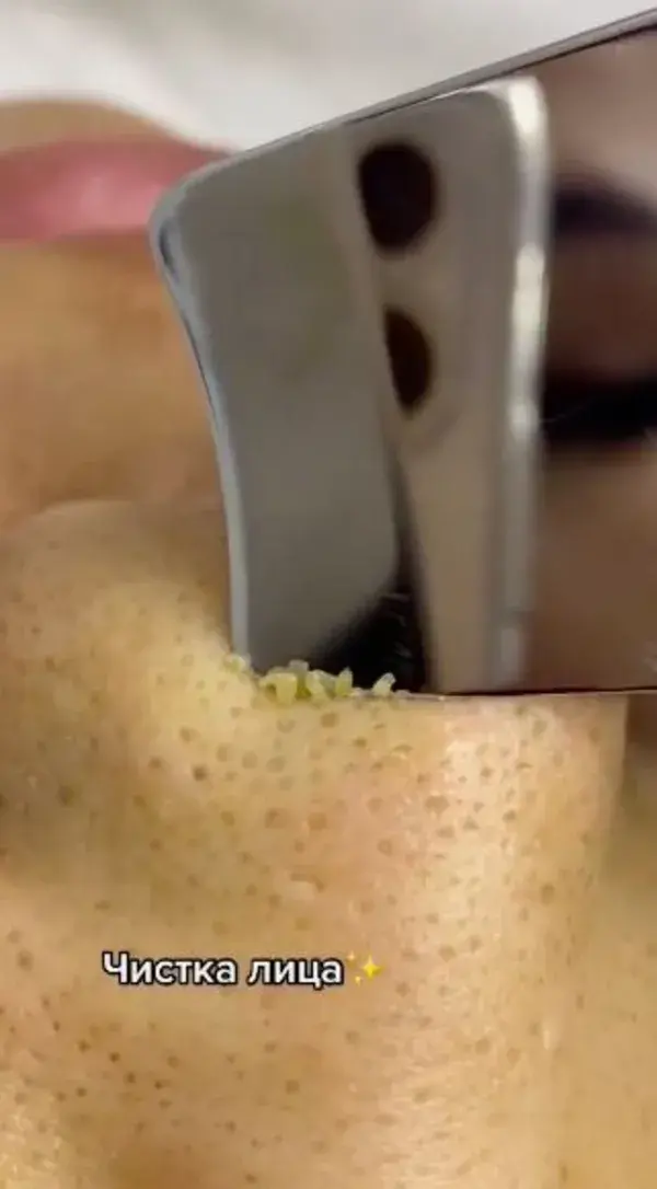 Blackheads removal popping