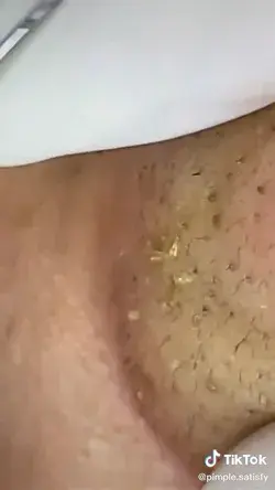 Blackheads satisfying popping