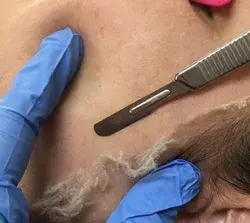 Dermaplaning