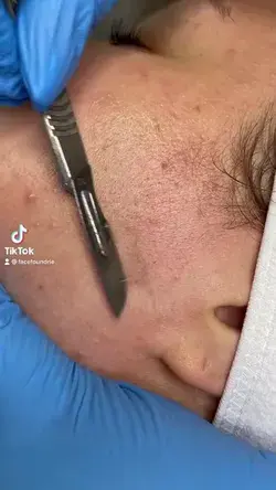 DERMAPLANING