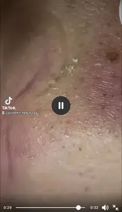 blackheads satisfying removal video