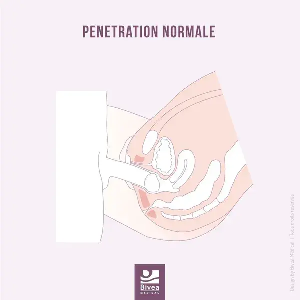 Pénétration normale VS Vaginisme