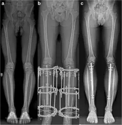 Cosmetic limb lengthening London | athensbjr.com