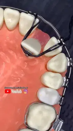 Behel bracet orthodontist
