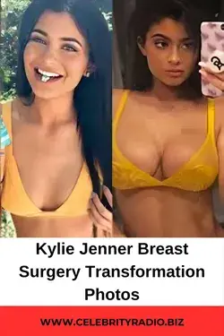 Kylie Jenner Breast Surgery Transformation Photos