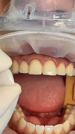 Minimal Prep Veneers