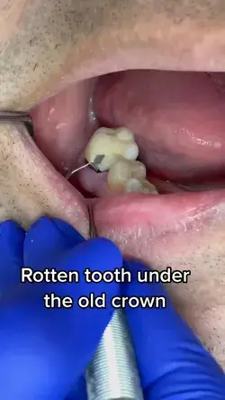 Rotten tooth under crown