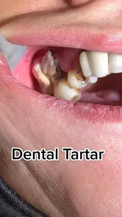 Dental tartar