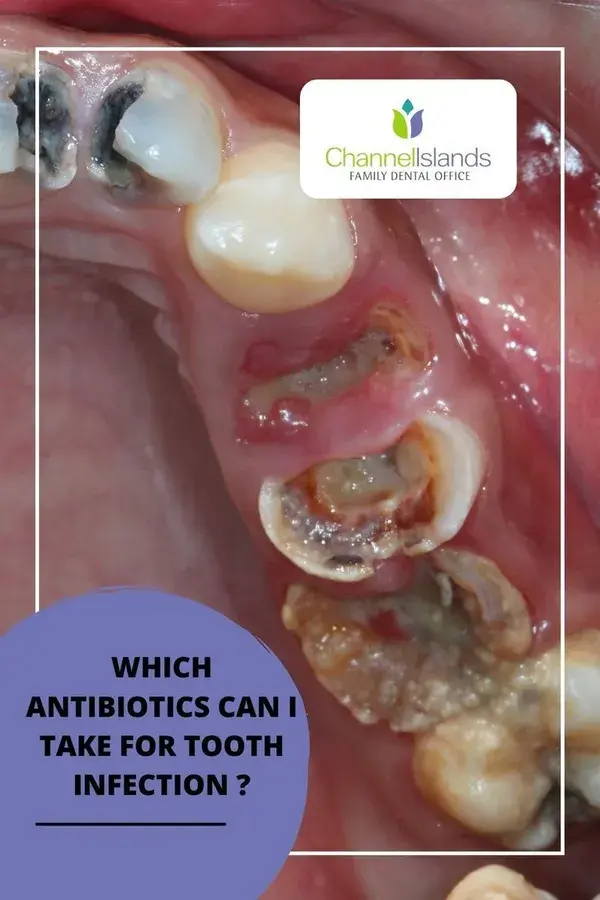 4 ANTIBIOTICS FOR TOOTH INFECTION