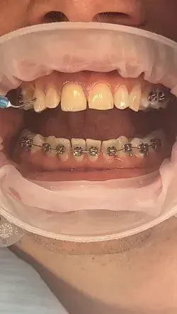 Damon Brace fitting - Kissdental