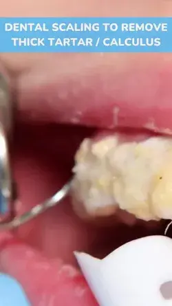 thick tartar plaque removal (satisfying result)