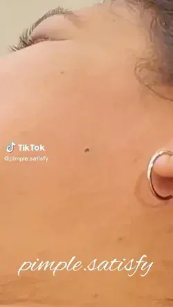 Satisfying Blackheads