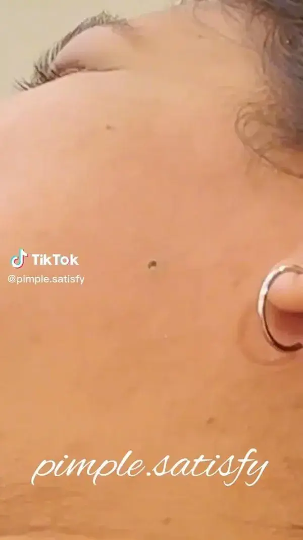 Satisfying Blackheads