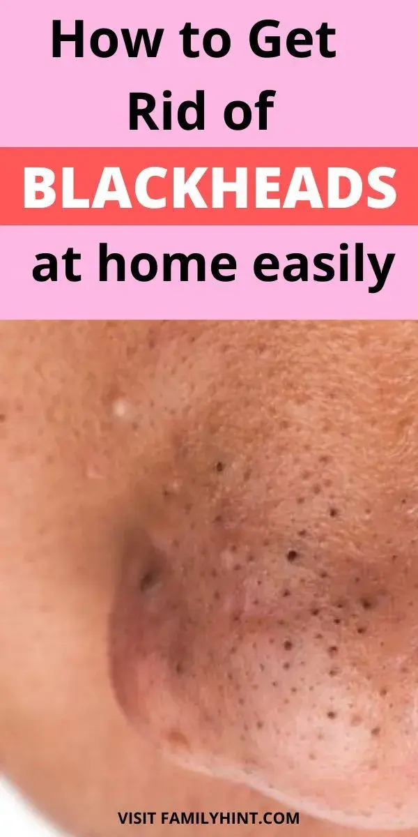 How to Get Rid of Blackheads on Nose Overnight: Blackhead Removal Remedies