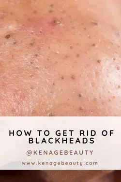 How to Get Rid Of Blackheads