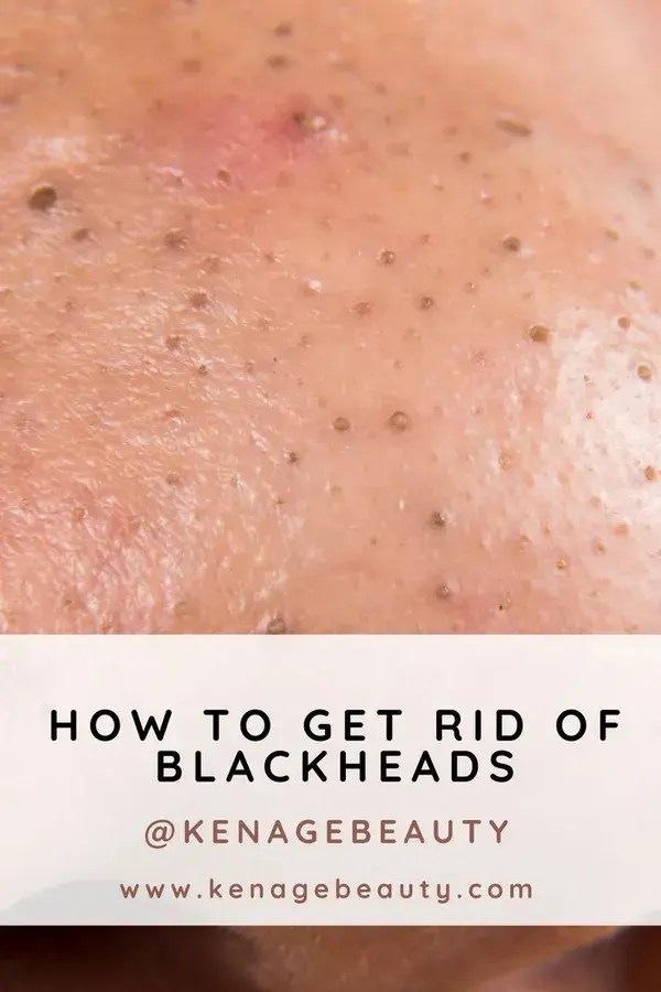 How to Get Rid Of Blackheads