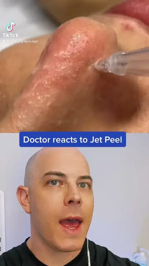 Doctor reacts to the amazing jet peel!