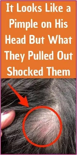 It Looks Like A Pimple On His Head 	 But What They Pulled Out Shocked Them