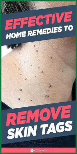 How to Remove Skin Tag in 1 Night