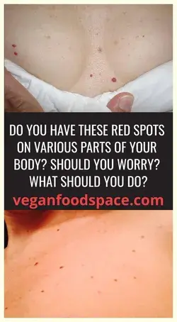 Do You Have These Red Spots On Various Parts Of Your Body!!!