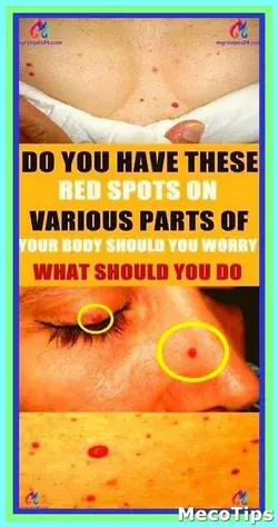 DO YOU HAVE THESE RED SPOTS ON VARIOUS PARTS OF YOUR BODY SHOULD YOU WORRY ? WHAT SHOULD YOU DO