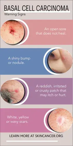 Basal Cell Carcinoma Warning Signs