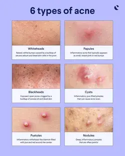 Acne Types - Blackheads, Whiteheads and beyond.