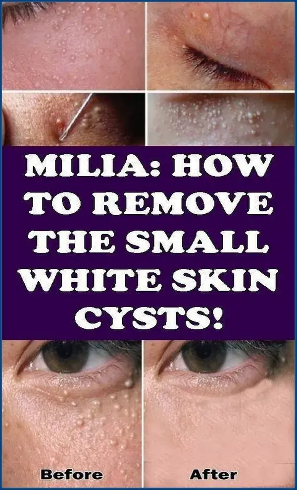 MILIA: HOW TO REMOVE THE SMALL WHITE SKIN CYSTS?