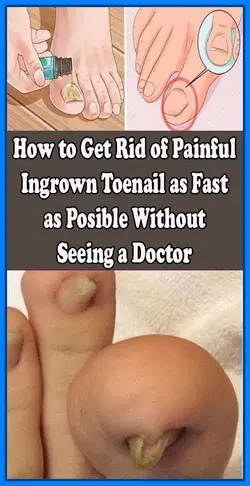 How To Get Rid Of A Painful Ingrain Nail Without a Doctor