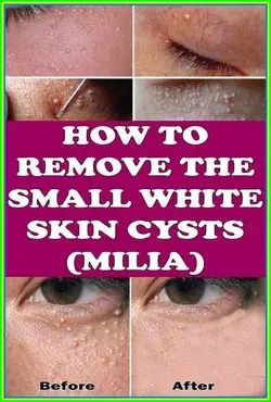 Milia - How to Remove the Small White Skin Cysts?