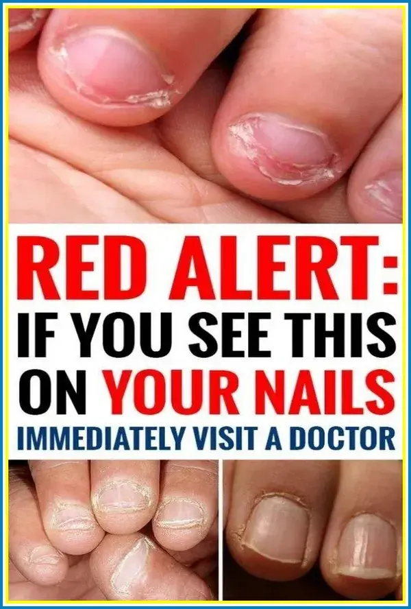 Red Alert - If You See This on Your Nails Immediately Visit a Doctor!