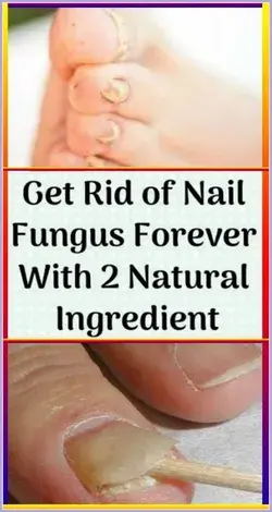 3 Simple and Effective Natural Cures for Toenail Fungus