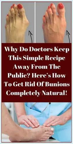 WHY DO DOCTORS KEEP THIS SIMPLE RECIPE AWAY FROM THE PUBLIC? HERE�S HOW TO GET RID OF BUNIONS