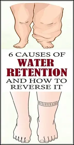 6 CAUSES OF WATER RETENTION AND HOW TO REVERSE IT