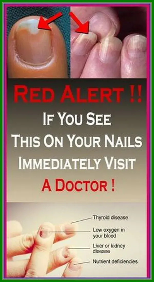 Red Alert: If You See This On Your Nails Immediately Visit A Doctor!